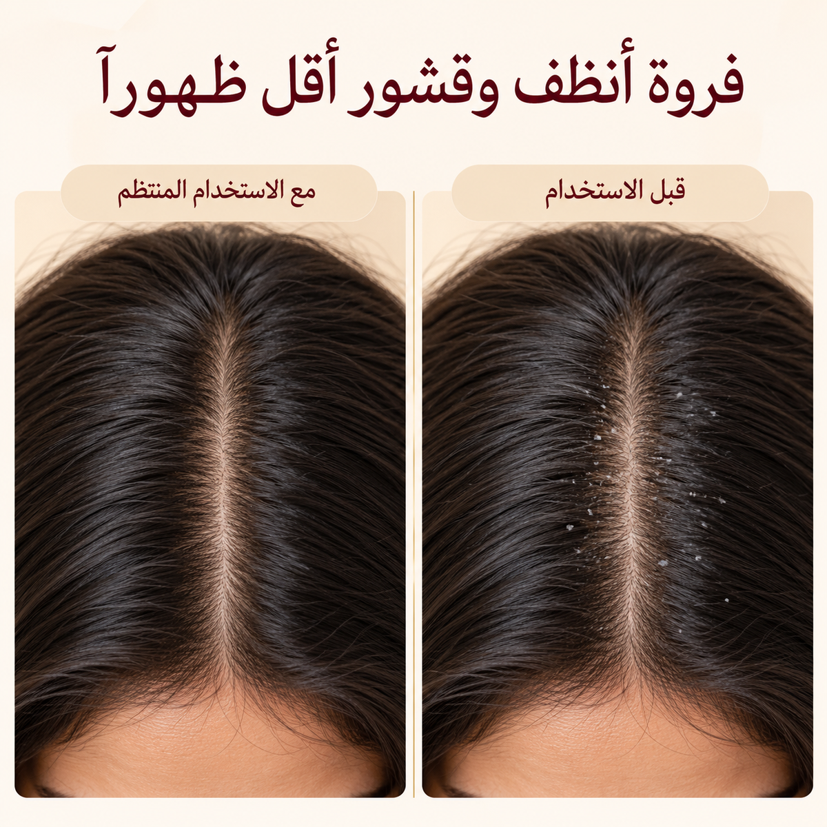 نتائج استخدام شامبو Velvet Root والعناية بالقشور الظاهرة